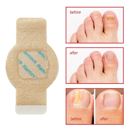#1 Fungal Nail Patches